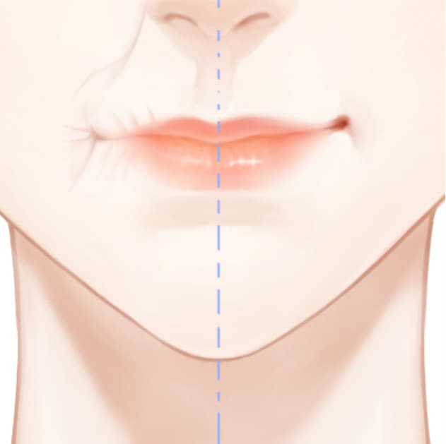玻尿酸淡化口周纹