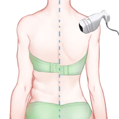 超声溶脂瘦背部
