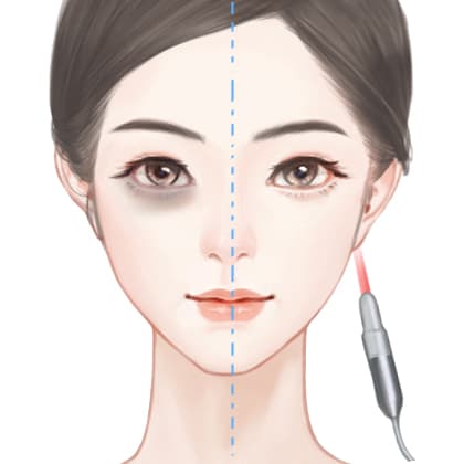 激光淡化黑眼圈